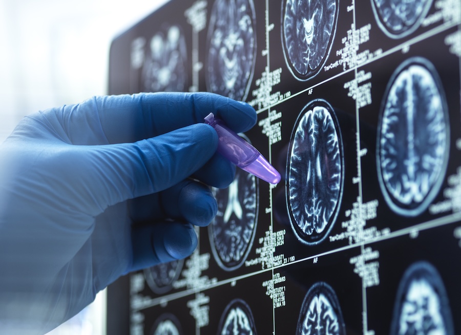 Dementia and Alzhiemer's Research, Scientist preparing human sample during a clinical trial